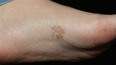 25 ++ age spots on back of hands 318237-How to get rid of age spots on back of hands ...