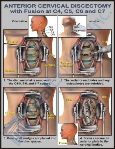 Anterior Cervical Discectomy w/ Fusion C4, C5, C6, C7 Cervical Spinal Stenosis, Cervical Disc ...