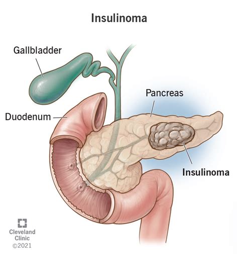 How Common Is Insulinoma In Dogs