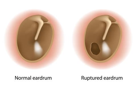 Myringoplasty - Repairing the eardrum - The right nose