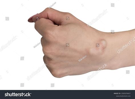 Ganglion cyst. Wrist ganglion cyst. Pain hand. - Royalty Free Stock Photo 2325570417 - Avopix.com