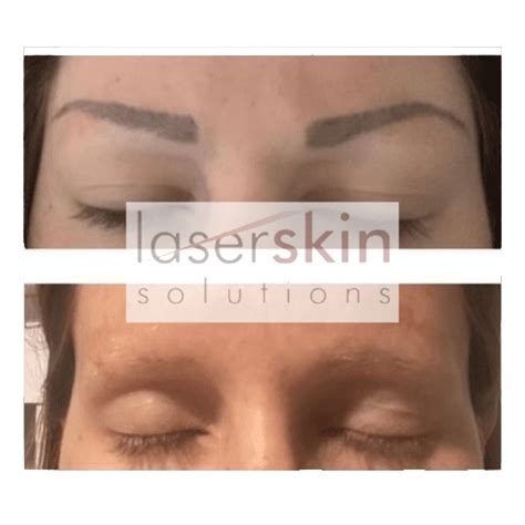 Eyebrow tattoo removal - Laser Skin Solutions