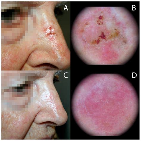 Blue Light Photodynamic Therapy For Actinic Keratosis | Shelly Lighting