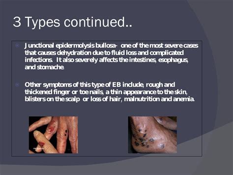 Epidermolysis Bullosa