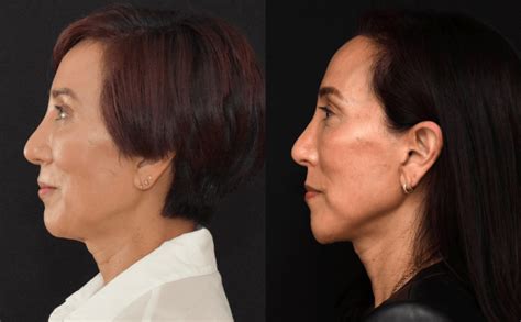 Lower Face and Neck Lift Surgery for Neck Contour - Brian P. Dickinson M.D.