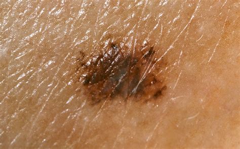 Melanoma in situ and mortality: is there cause for concern? - Hospital Healthcare Europe