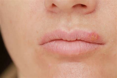 Mix · Lip Dermatitis - 7 Natural Home Remedies For Lips Eczema