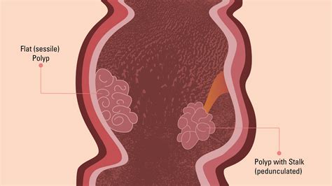 Types of Colon Polyps: Colon Polyp Symptoms and Risk Factors