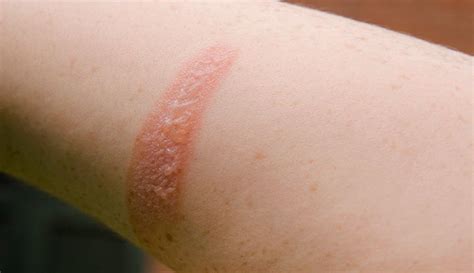 2nd-Degree Burn: What It Looks Like, Treatment & Healing