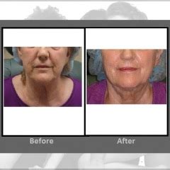 Titan Skin Tightening Procedure | Hartford CT