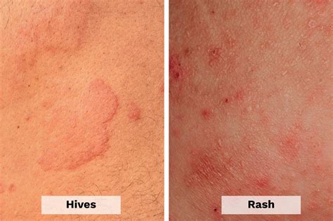 Difference Between Hives And Scabies Hives Vs Scabies - Riset