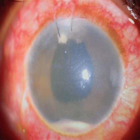 How to Get Rid of Corneal Edema After Cataract Surgery – Eye Surgery Guide