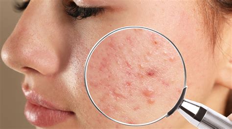 Acne Scars And Dark Spots: What Are They And How Do You Get Rid Of Them?