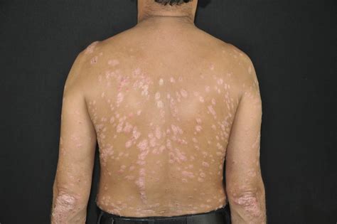 Guttate Psoriasis