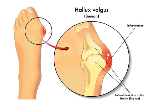 Understanding Bunions: What They Are & What Causes Them - Dr. McHugh And Associates P C ...