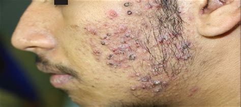 Pseudo Acne Fulminans: An Under Recognized Entity : Indian Dermatology ...