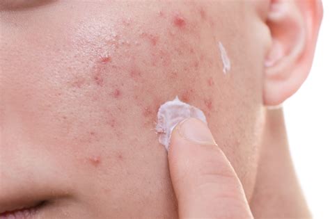 Topical Antibiotics For Treating Acne