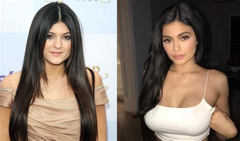 Kylie Jenner Plastic Surgery Before And After Kylie Jenner Plastic Surgery Has Raised Lots Of ...