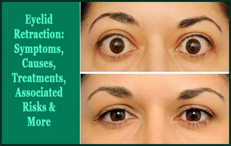 Eyelid Retraction: Symptoms, Causes, Treatments, Associated Risks & More | Eyelid lift, Dry ...