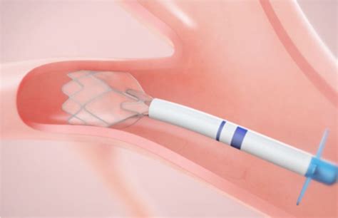 Diagnostics/Therapeutics - Mass Lung & Allergy PC