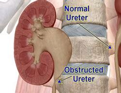 Pyeloplasty | Life Care Nursing Home