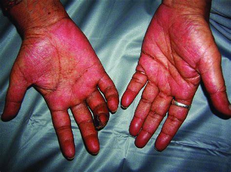 Palmar Erythema Symptoms Causes Treatment And More | Images and Photos finder