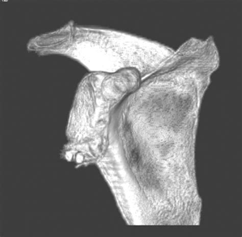 iliac crest bone graft technique - ModernHeal.com