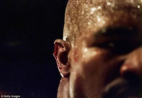 Evander Holyfield's ear after he was bitten by Mike Tyson during their ...