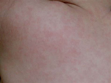 Mild Shingles Rash On Arm