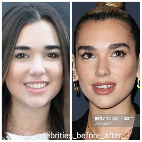 Celebrity Plastics ★ on Instagram: “🤫 Before/After: @dualipa. Follow ...