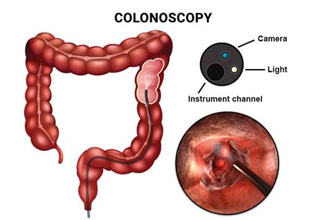 #1 Prep Instructions for Your Colonoscopy - Manhattan Gastroenterology