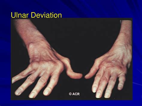 Ulnar Deviation