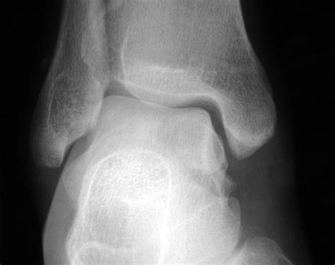 Comminuted fracture of the talus not visible on the initial radiograph ...