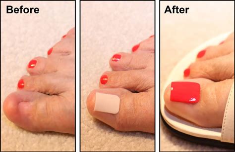 Acrylic Toe Nails, French Tip Acrylic Nails, Toenail Fungus Remedies, Toenail Fungus Treatment ...