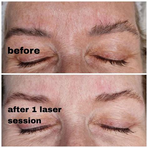 Laser Removal of Permanent Makeup - TANIA BHANGOO PERMANENT MAKEUP