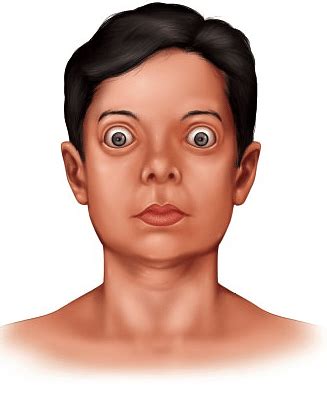 Exophthalmic Goitre: Causes, Symptoms, Treatment, Diet and much more