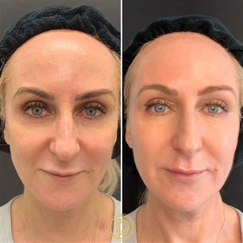 Is Sculptra a Liquid Facelift? How Long Does It Last? | Dallas Dermatology