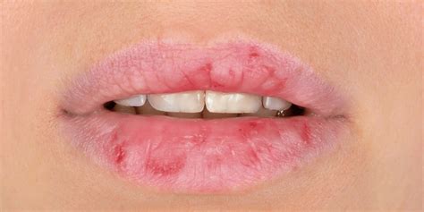 What Causes Continuous Chapped Lips | Sitelip.org