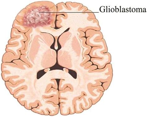 Glioblastoma Multiforme Explained – Boston Neurosurgery