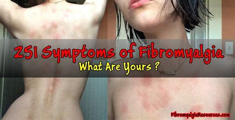 Pin by Kristine Beeson on fibro spoonie | Fibromyalgia, Fibromyalgia ...