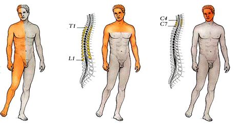 Hemiplegia vs. Hemiparesis: Differences and Managements | New Health Advisor