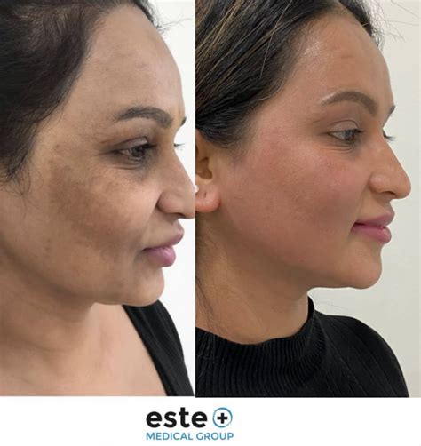 Skin Pigmentation Treatment | Este Medical Group