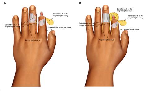 Figure 1 from The Clinical Effect of Digital Dorsal Fascial Island Flap Combined With ...