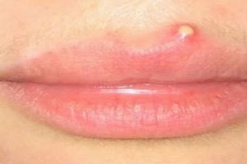 Understanding Pimples on the Lips: When to Seek Professional Help for It