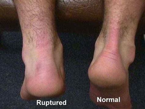 Health And Beauty Tips: Symptoms of Achilles tendon rupture