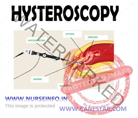 HYSTEROSCOPY - Nurse Info