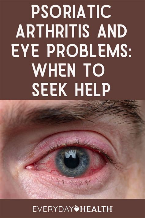 Psoriatic Arthritis and Eye Problems | Everyday Health in 2021 ...