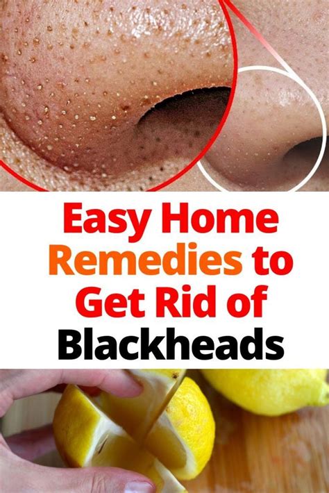 Easy Home Remedies to Get Rid of Blackheads - How To Be Fit in 2020 | Get rid of blackheads ...