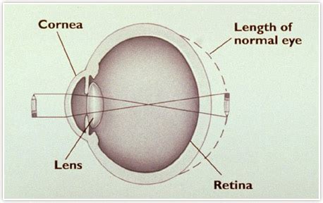 Farsightedness Detroit | Hyperopia Specialist Rochester, MI