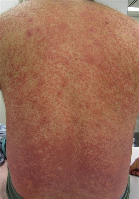 Vasculitis as related to Polymyalgia Rheumatica - Pictures